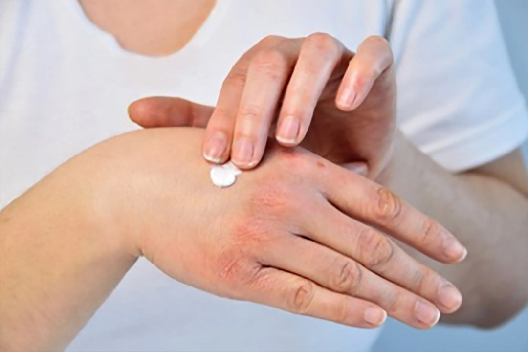 Antihistamines Could Be Drying Your Skin