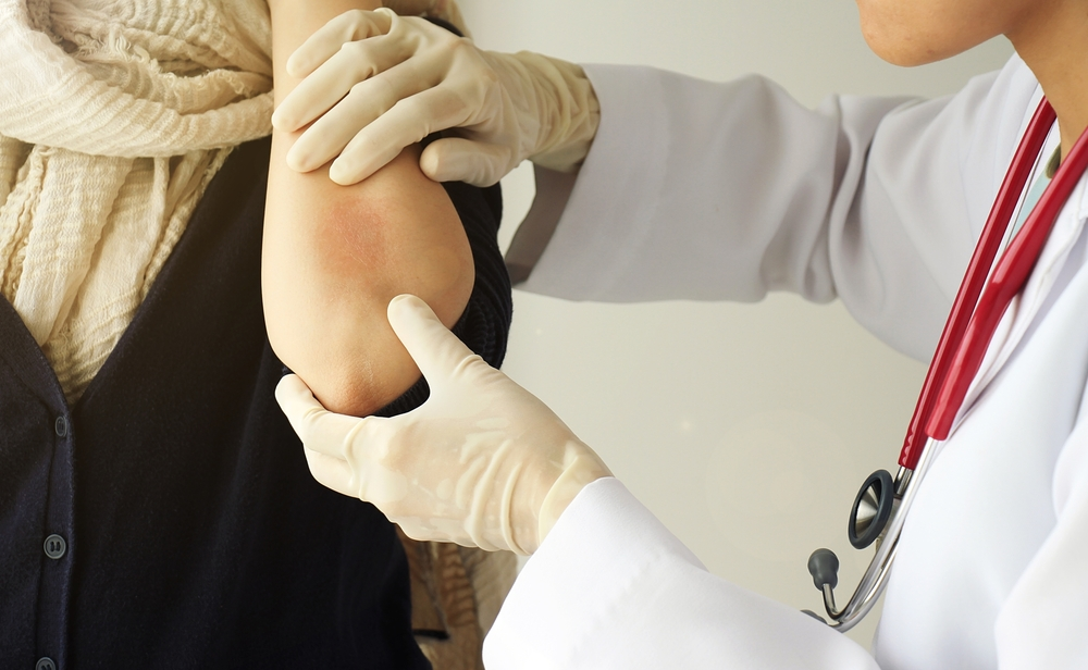Inverse Psoriasis vs. Intertrigo