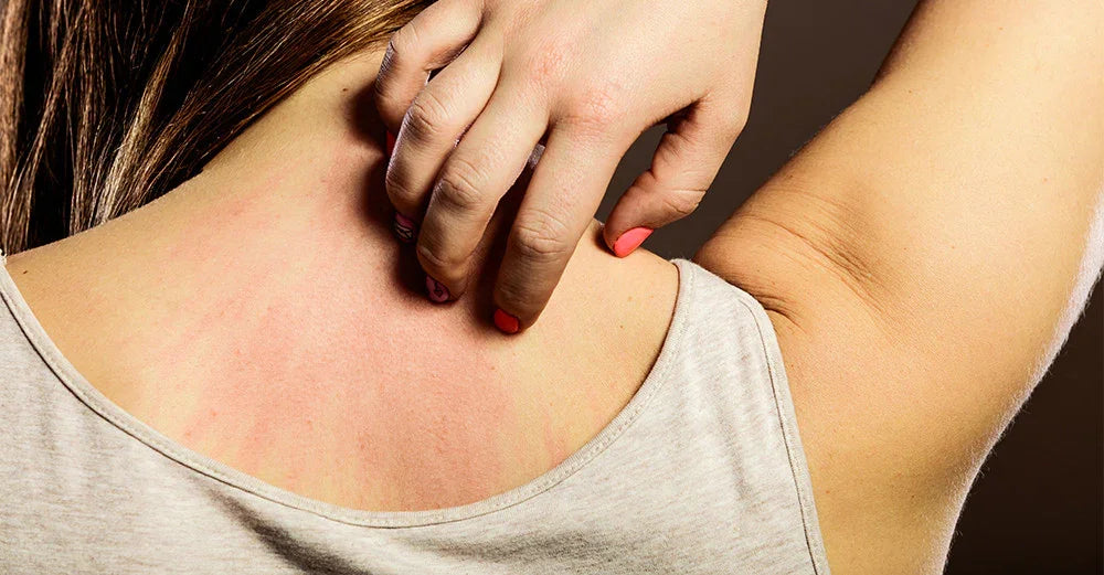 Woman scratching irritated red skin on neck, showing eczema and sensitive skin symptoms