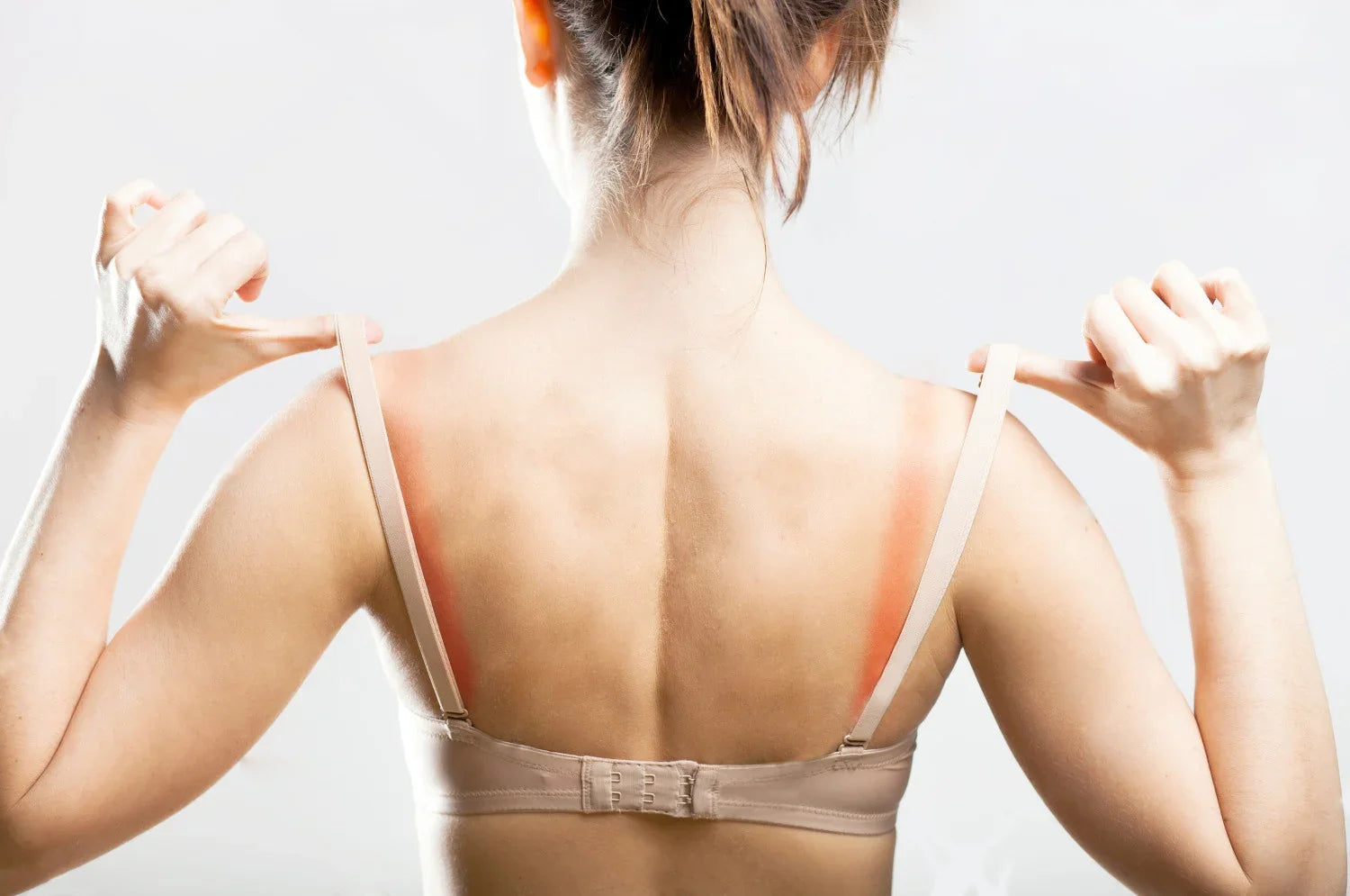 Woman with visible bra strap rash on back, highlighting clothing allergy, Cottonique hypoallergenic apparel