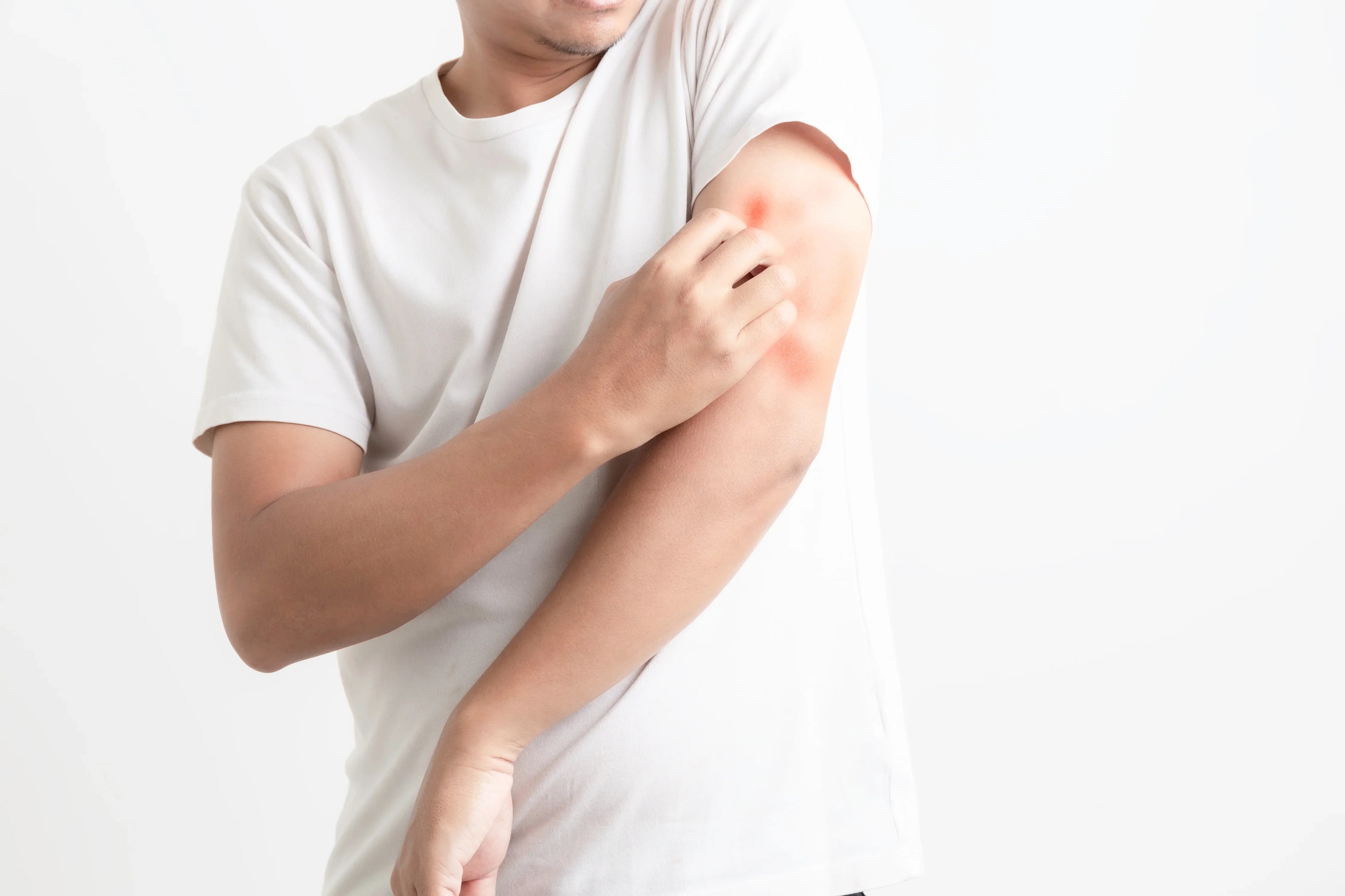 Man scratching red, irritated skin on arm, eczema and allergy symptoms, white shirt, white background
