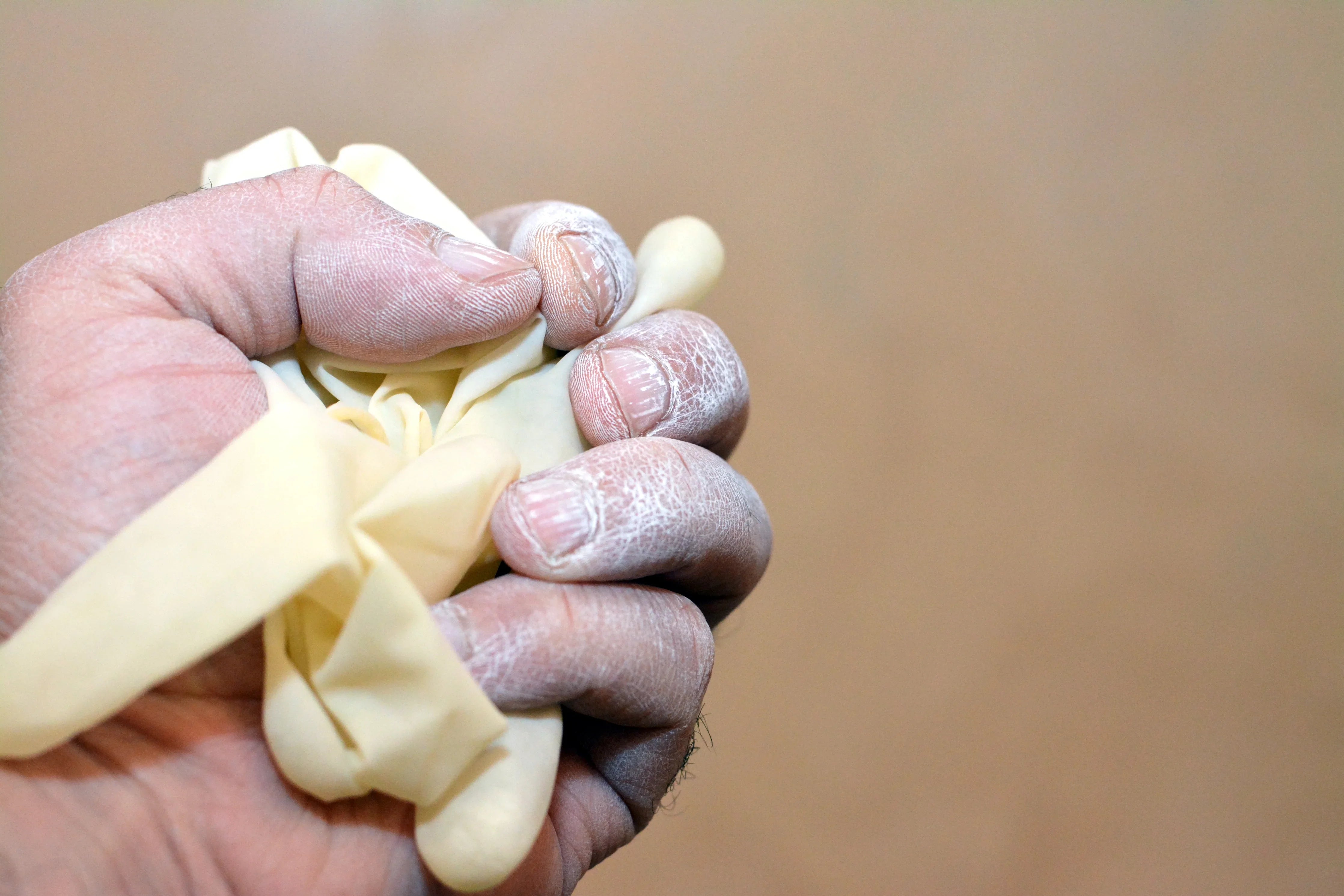 Hand with white powder residue and irritation from latex glove, showing skin sensitivity.