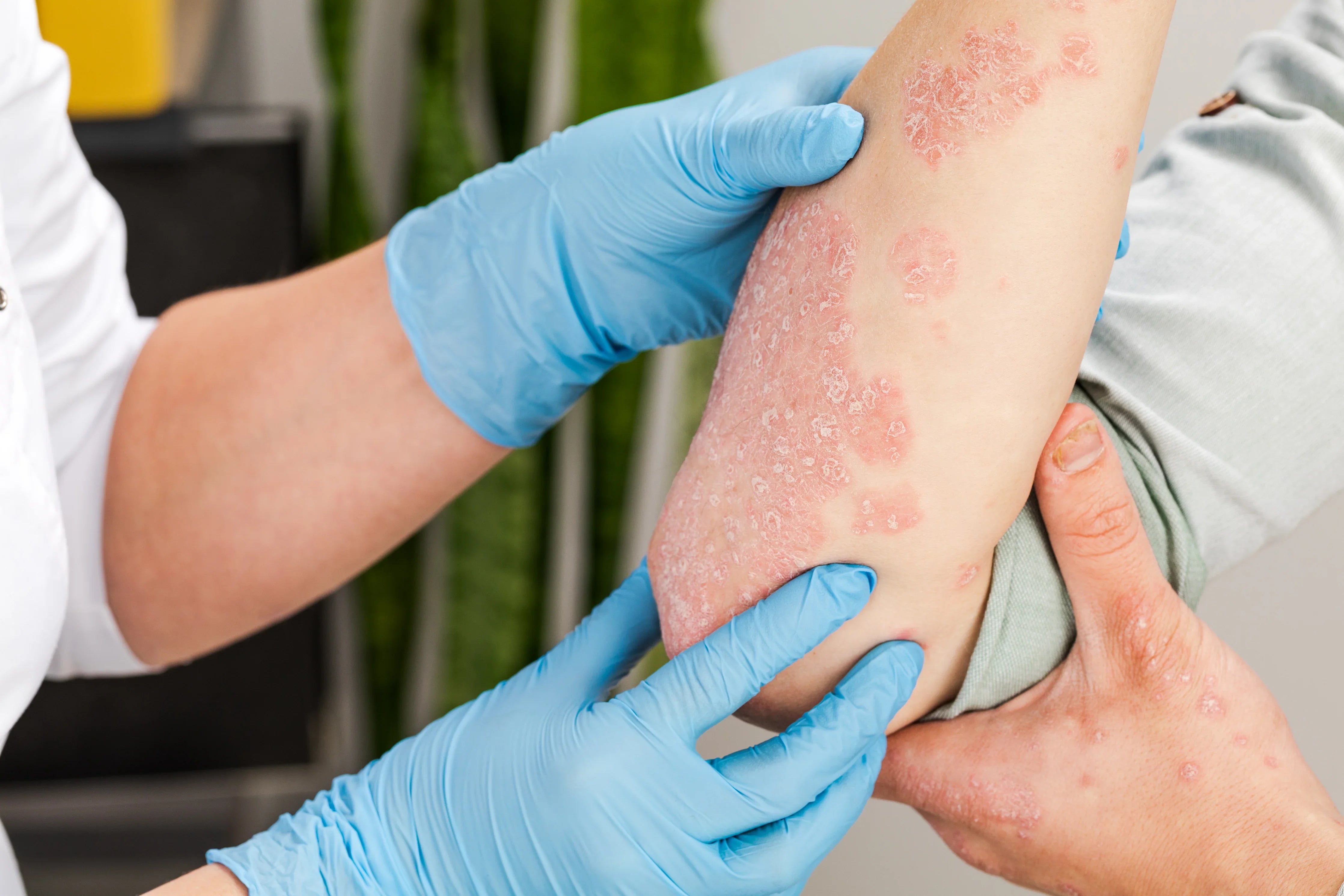 Dermatologist examining red, scaly psoriasis patches on a person's arm, allergy-free apparel context