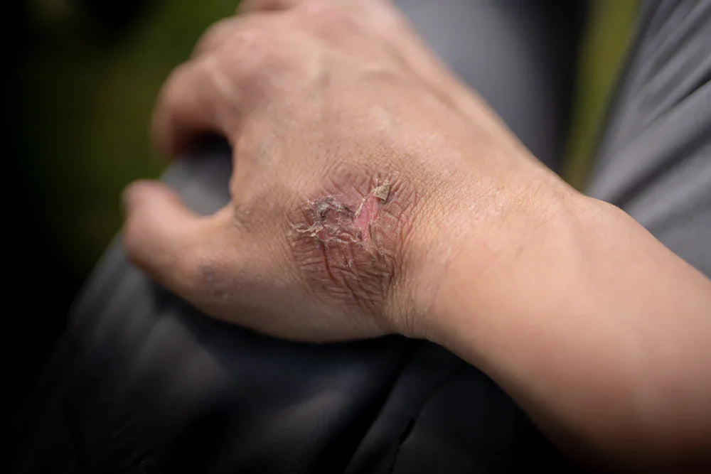 Close-up of irritated, dry skin on hand, showing possible eczema or allergic reaction