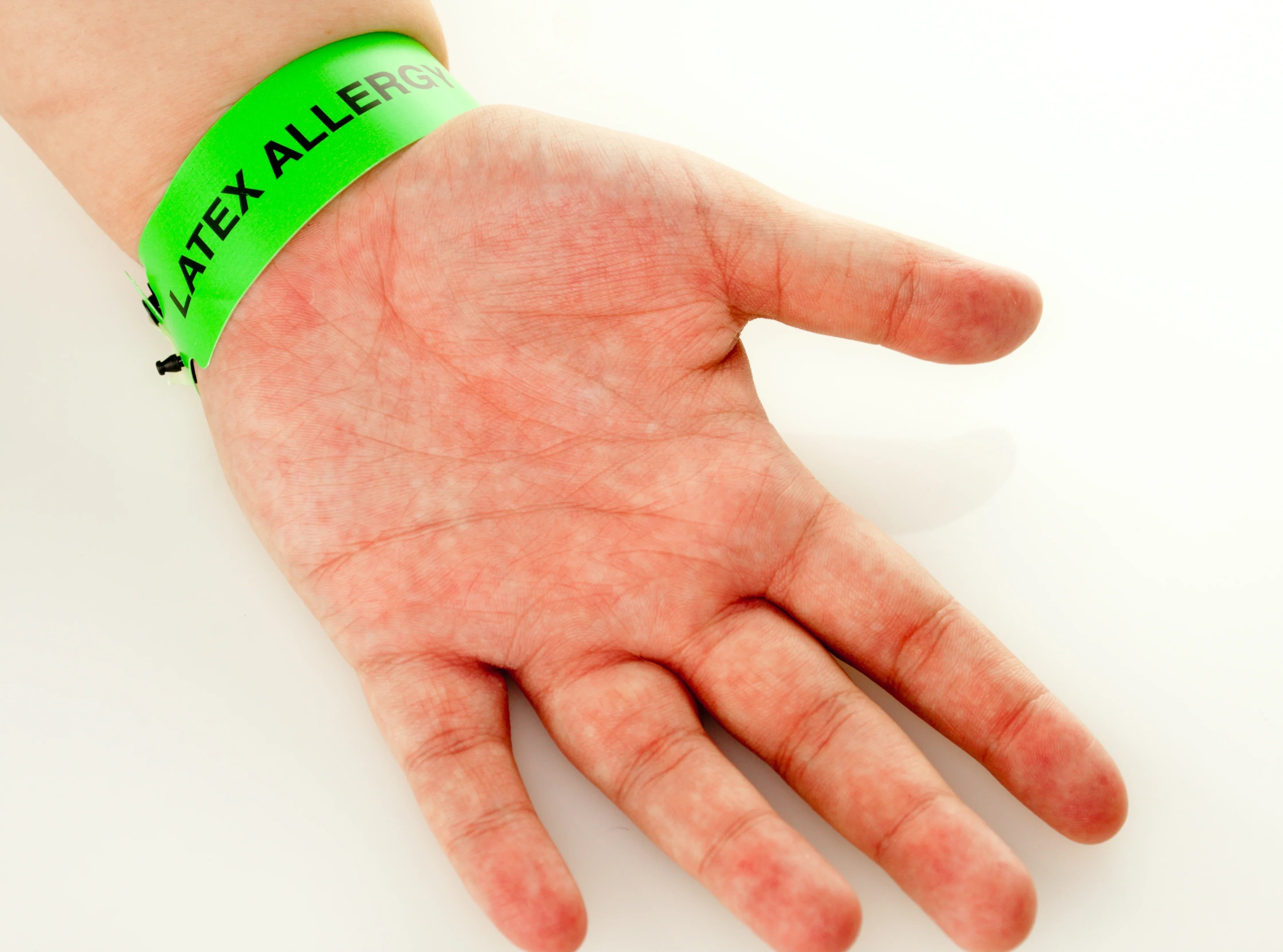 Hand with green latex allergy medical alert wristband for sensitive skin awareness