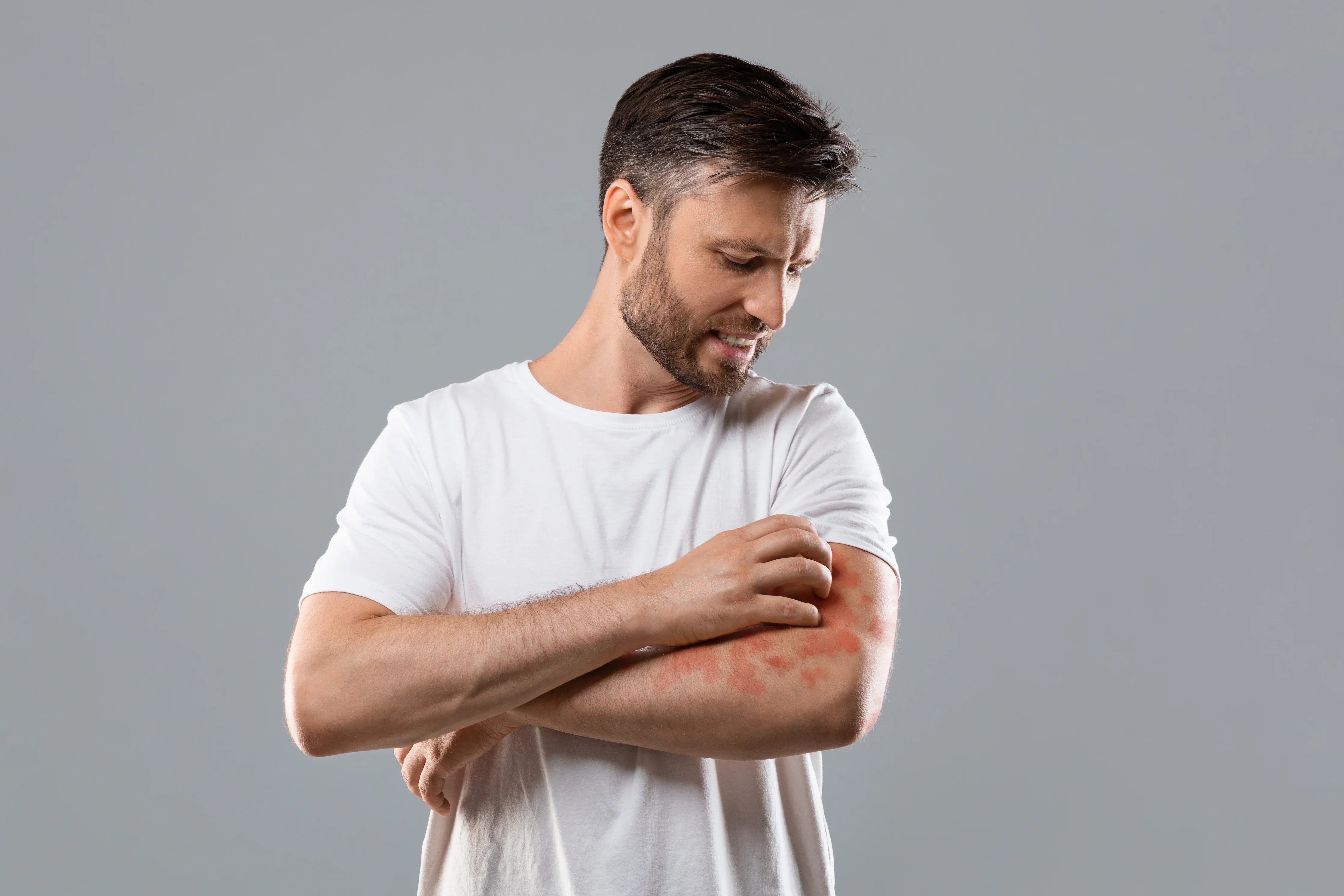Man in white shirt scratching red irritated skin on arm, cotton allergy-free apparel theme