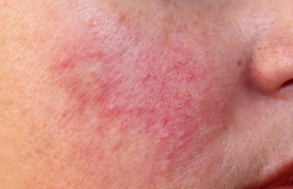 Close-up of red, irritated skin on a cheek, showing sensitive skin or rosacea symptoms.