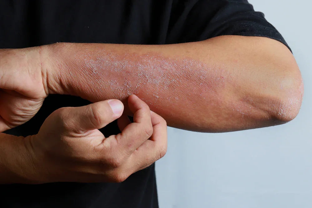 Person scratching eczema or allergic rash on forearm, skin irritation from clothing allergy