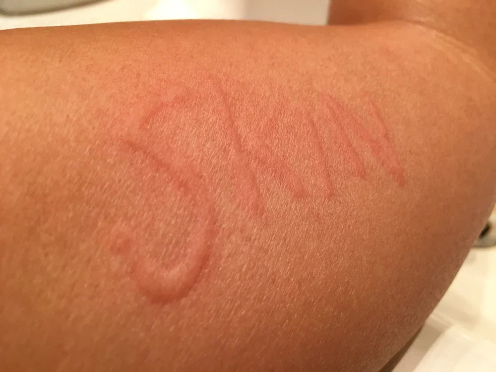 Prevent Dermatographia From Itching Too Much
