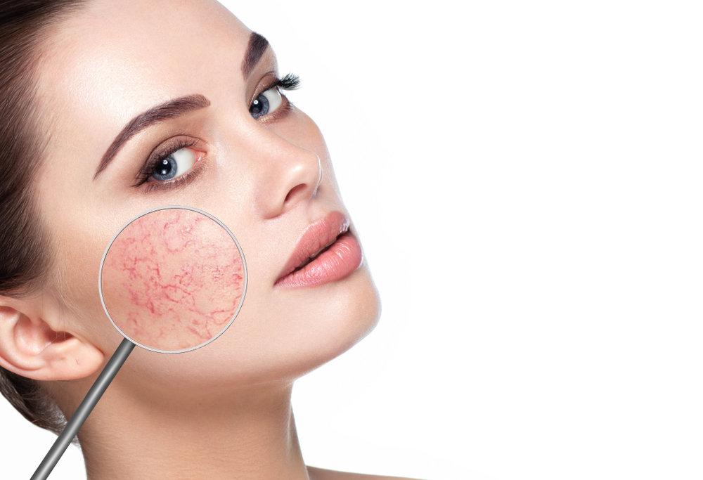 Treating Rosacea the Natural Way