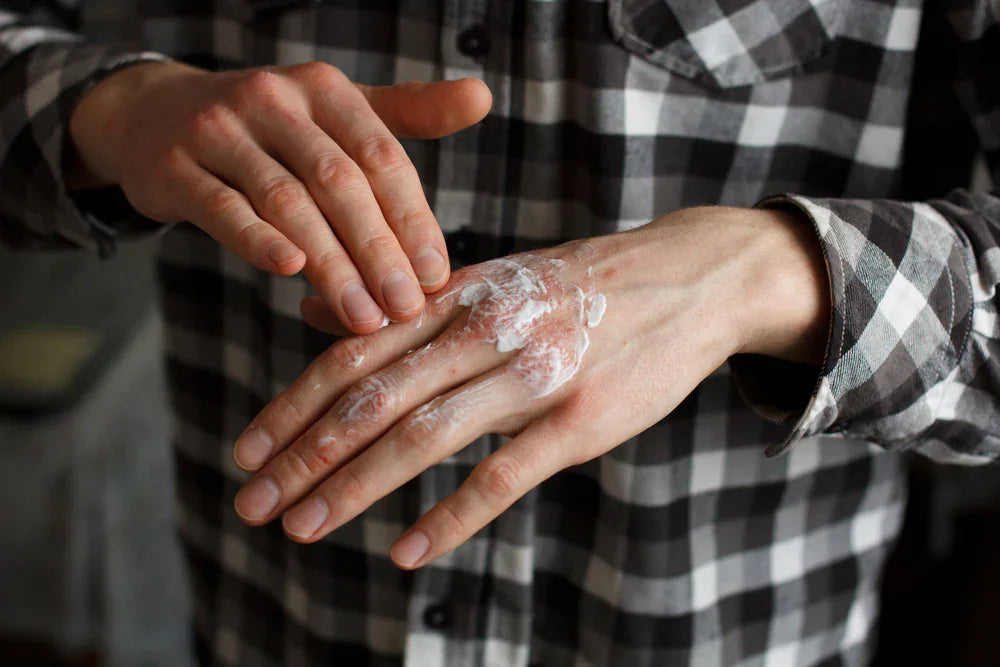 Person applying cream to irritated hand, wearing plaid shirt, allergy relief skincare