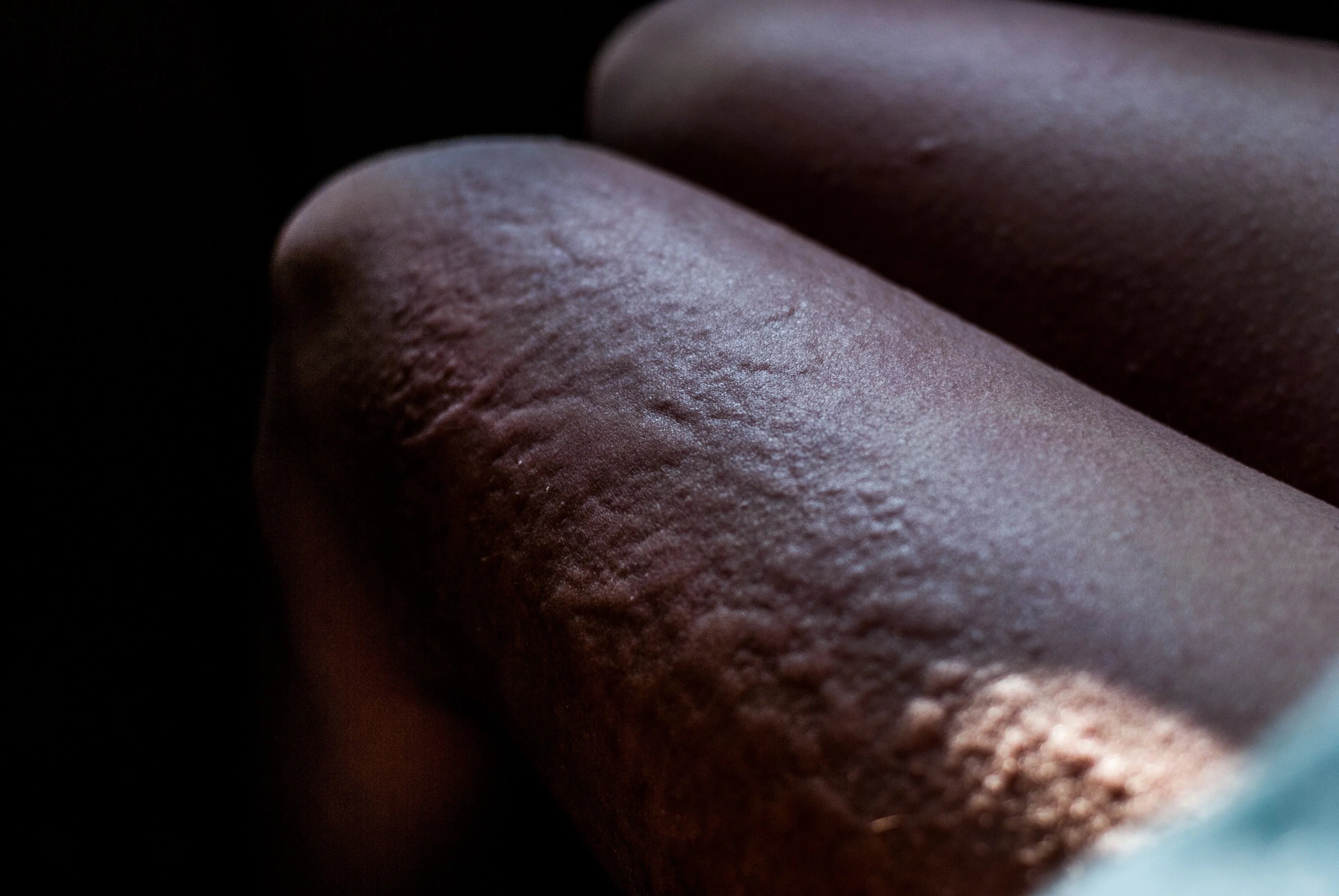 Close-up of dry, irritated skin on legs, illustrating clothing allergy concerns