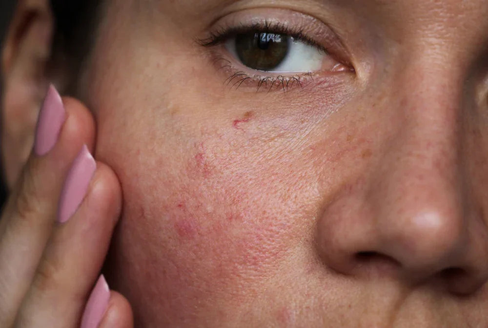 Close-up of irritated, red skin on a person's cheek, showing possible fabric allergy reaction.