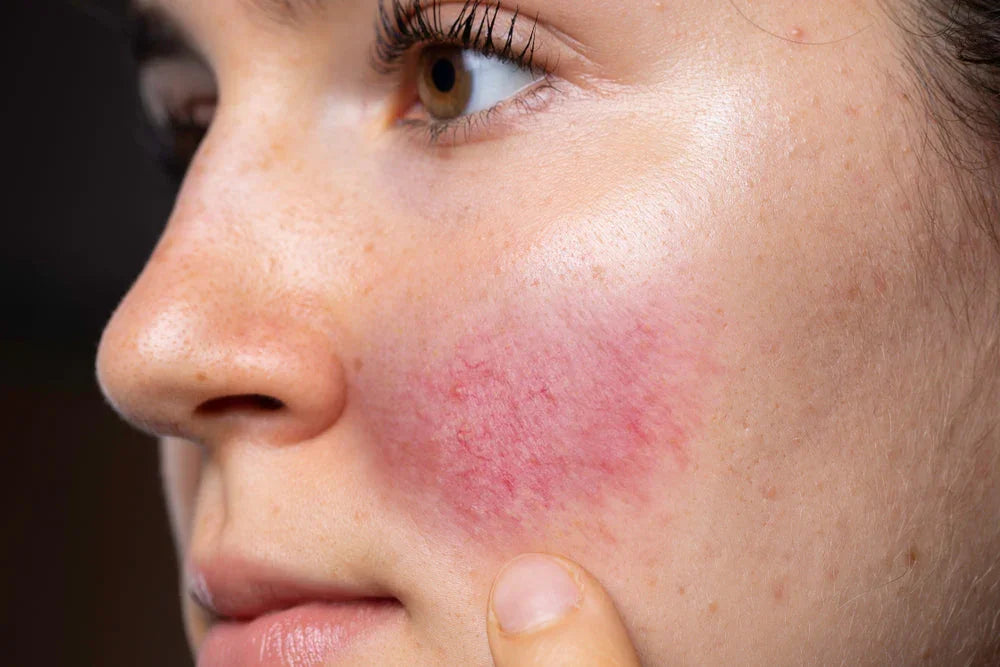 Close-up of a person's cheek with red, irritated skin, possible allergy reaction