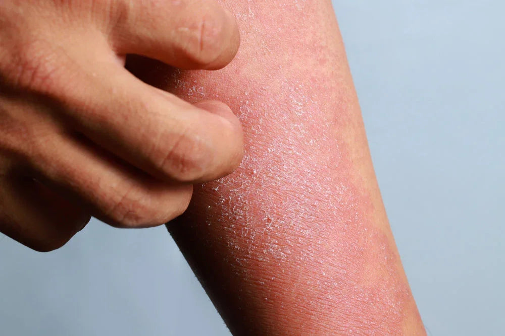 Close-up of person scratching irritated, dry skin on forearm, showing signs of eczema or skin allergy.