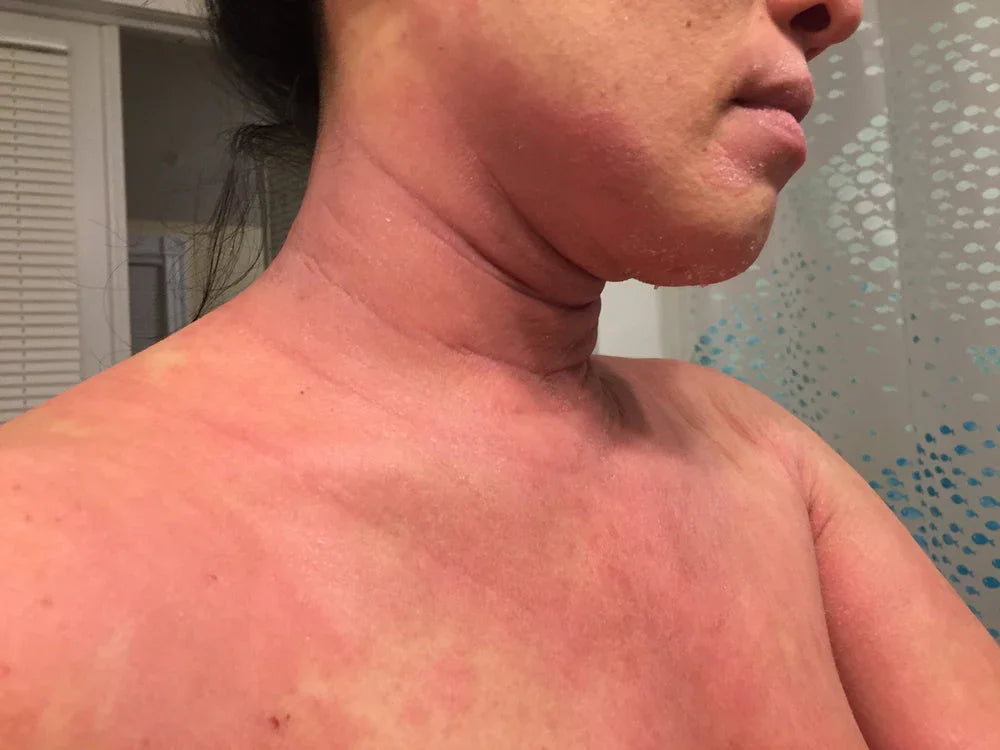 Person with visible skin irritation and redness on face, neck, and chest, possible clothing allergy