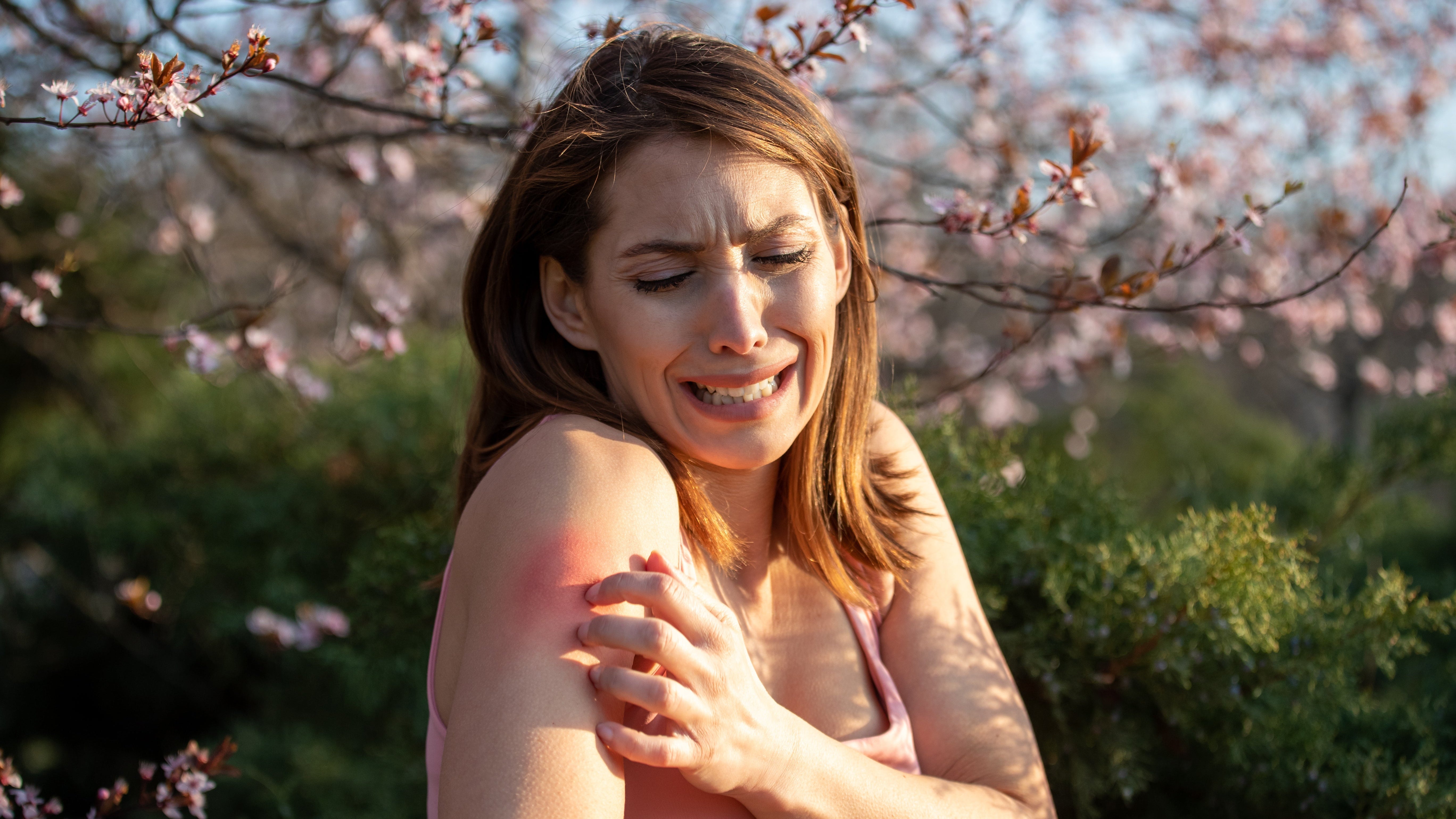 Woman outdoors scratching irritated red skin on shoulder, showing signs of eczema or allergy