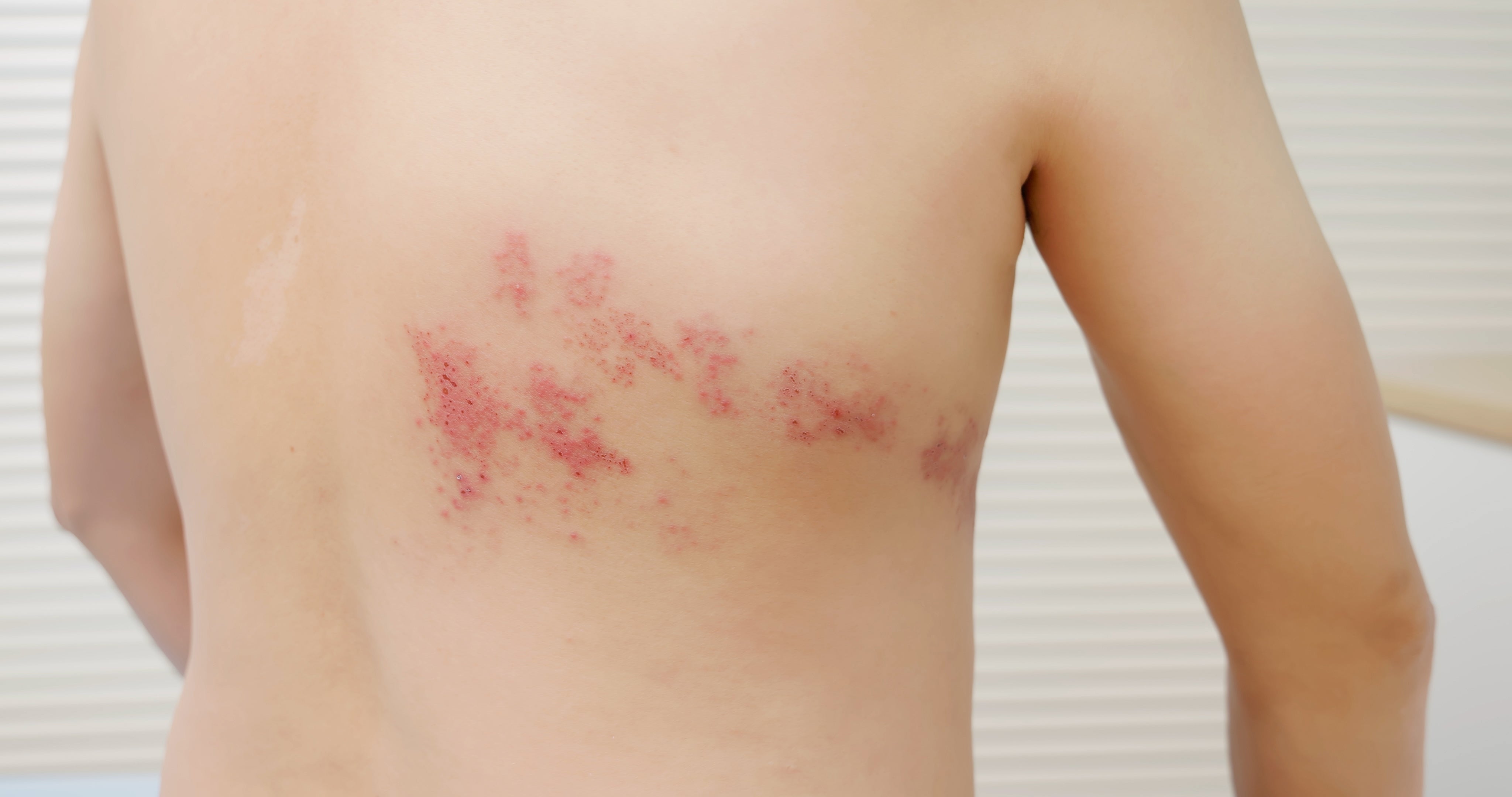 Close-up of red skin rash on adult back, common with sensitive skin or eczema