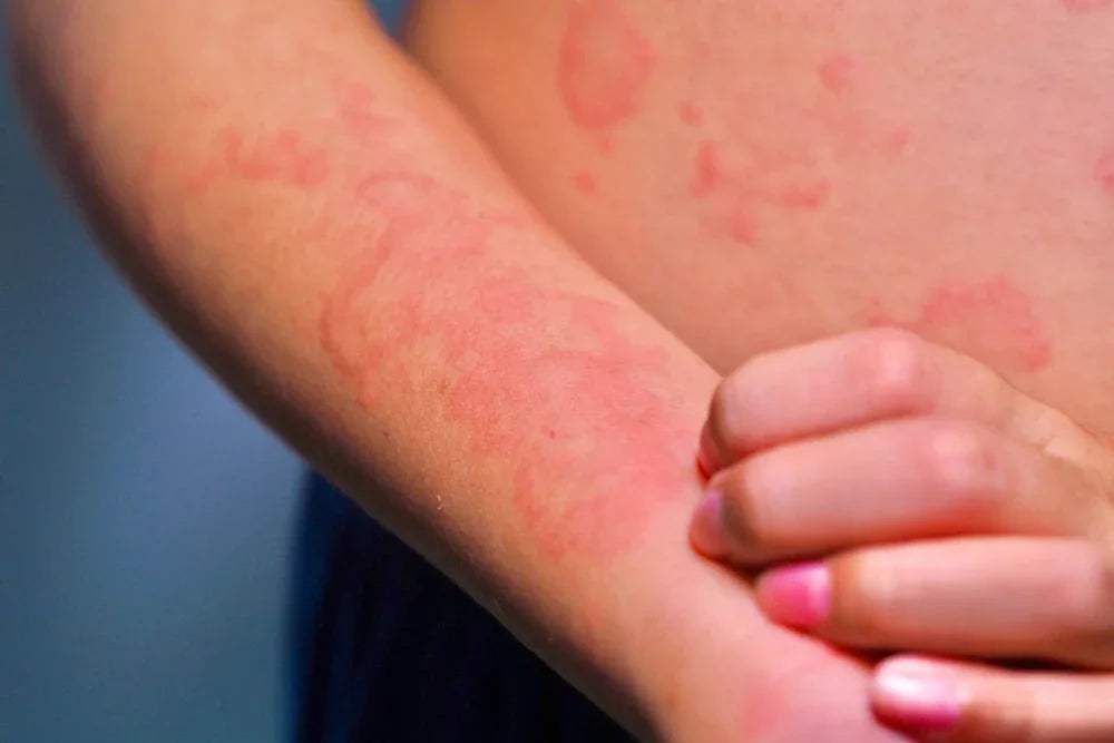 Close-up of irritated skin with red allergic rash, highlighting clothing allergy reaction