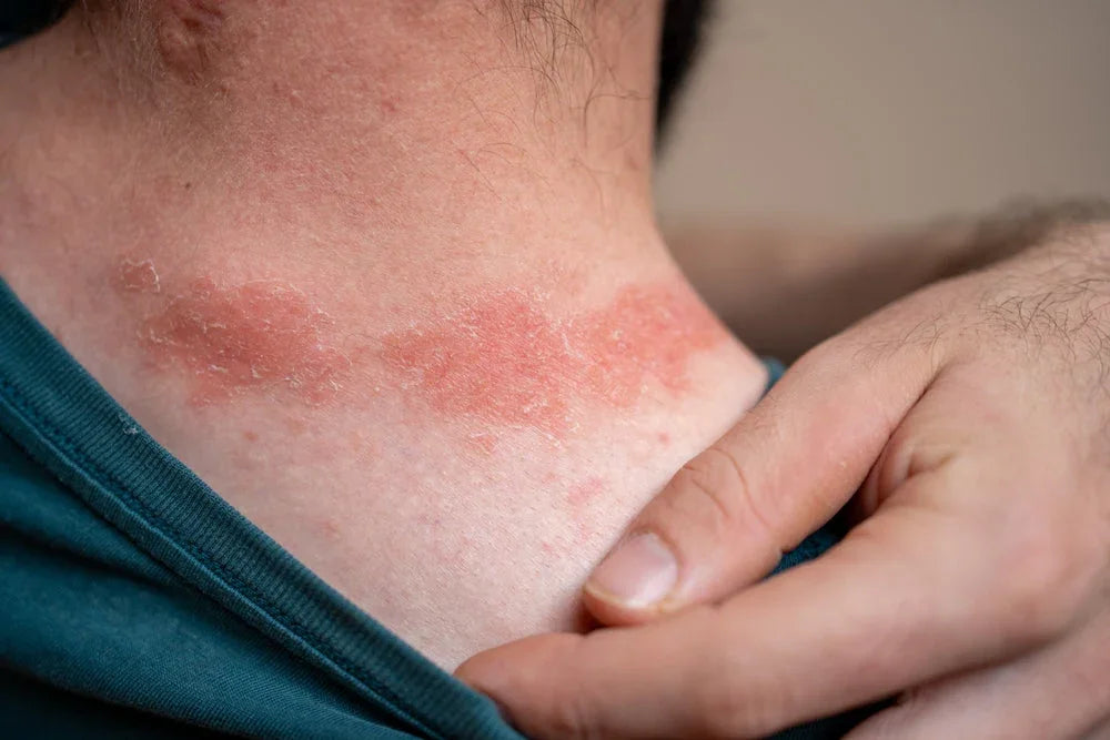 Red itchy skin rash on neck from clothing allergy, highlighting need for hypoallergenic apparel