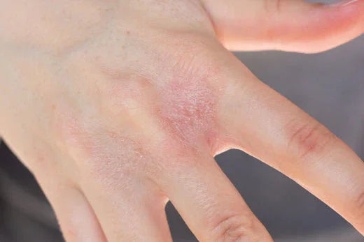 Close-up of a hand with red, irritated skin, showing an allergic skin reaction, relevant to hypoallergenic apparel.