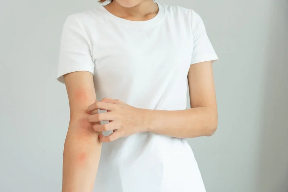 Woman in white t-shirt scratching arm with visible skin irritation, allergy reaction concept
