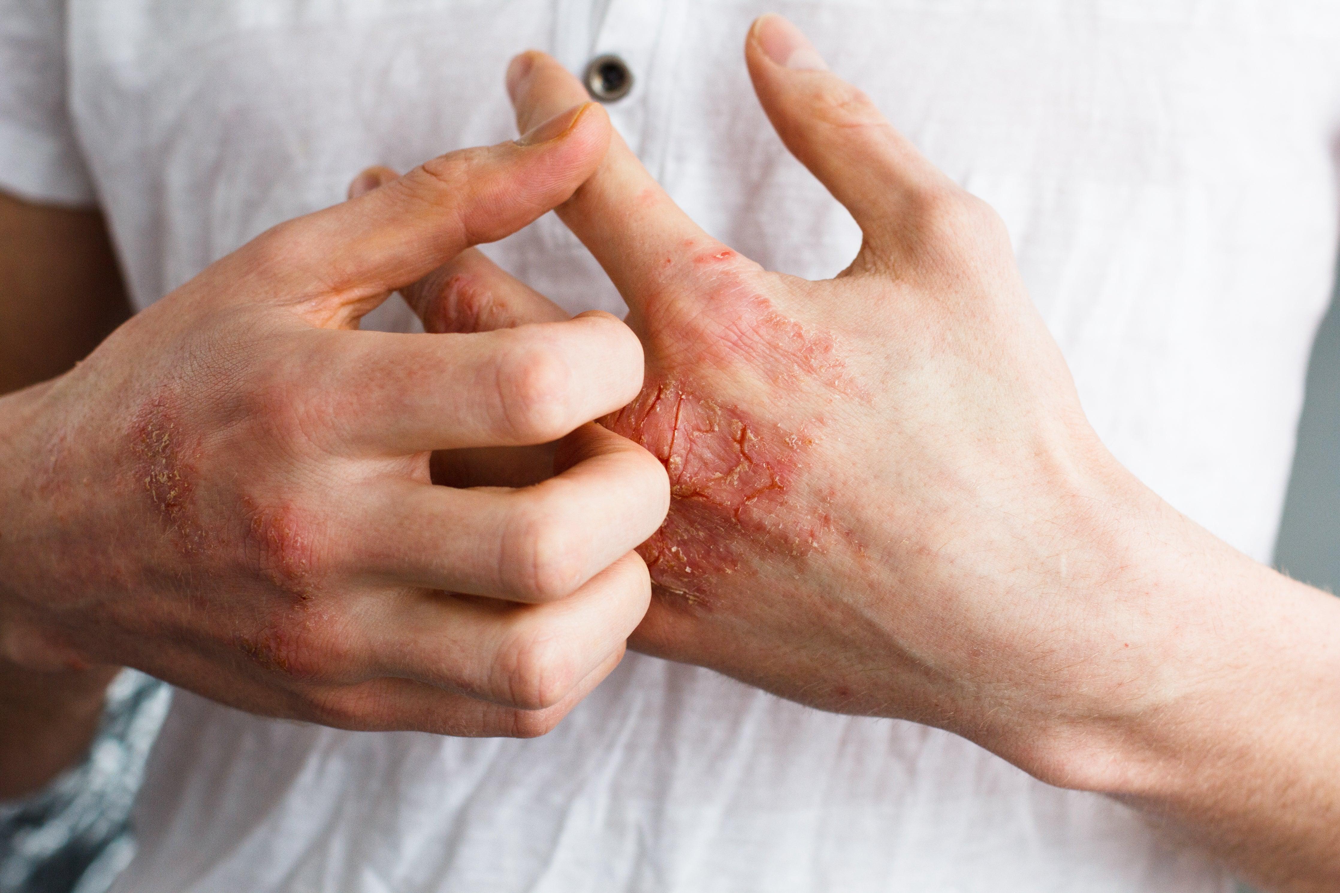 Person scratching irritated skin on hand with eczema, wearing a white cotton shirt
