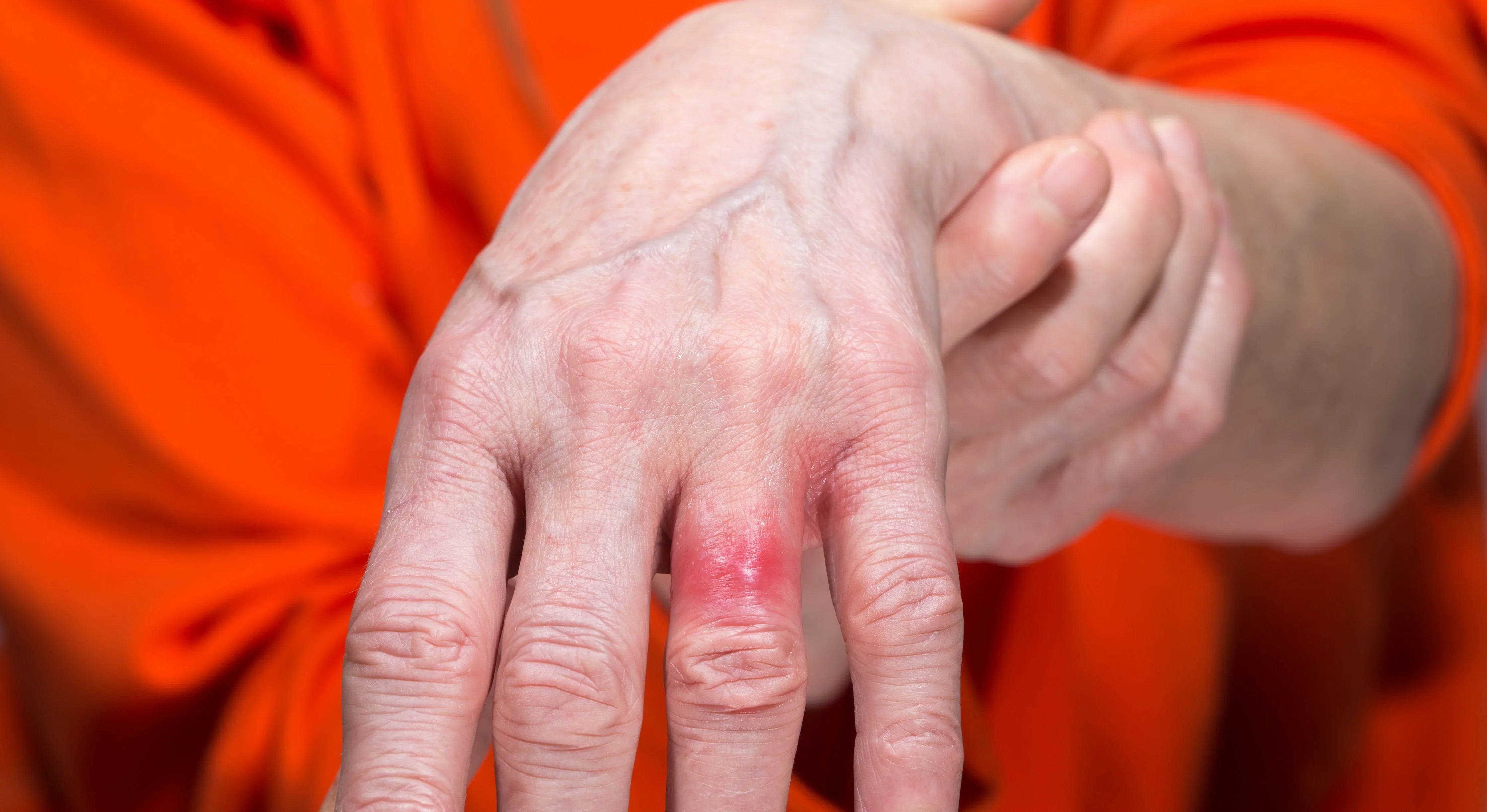 Hand with red skin irritation, possible allergy, highlighting need for hypoallergenic apparel