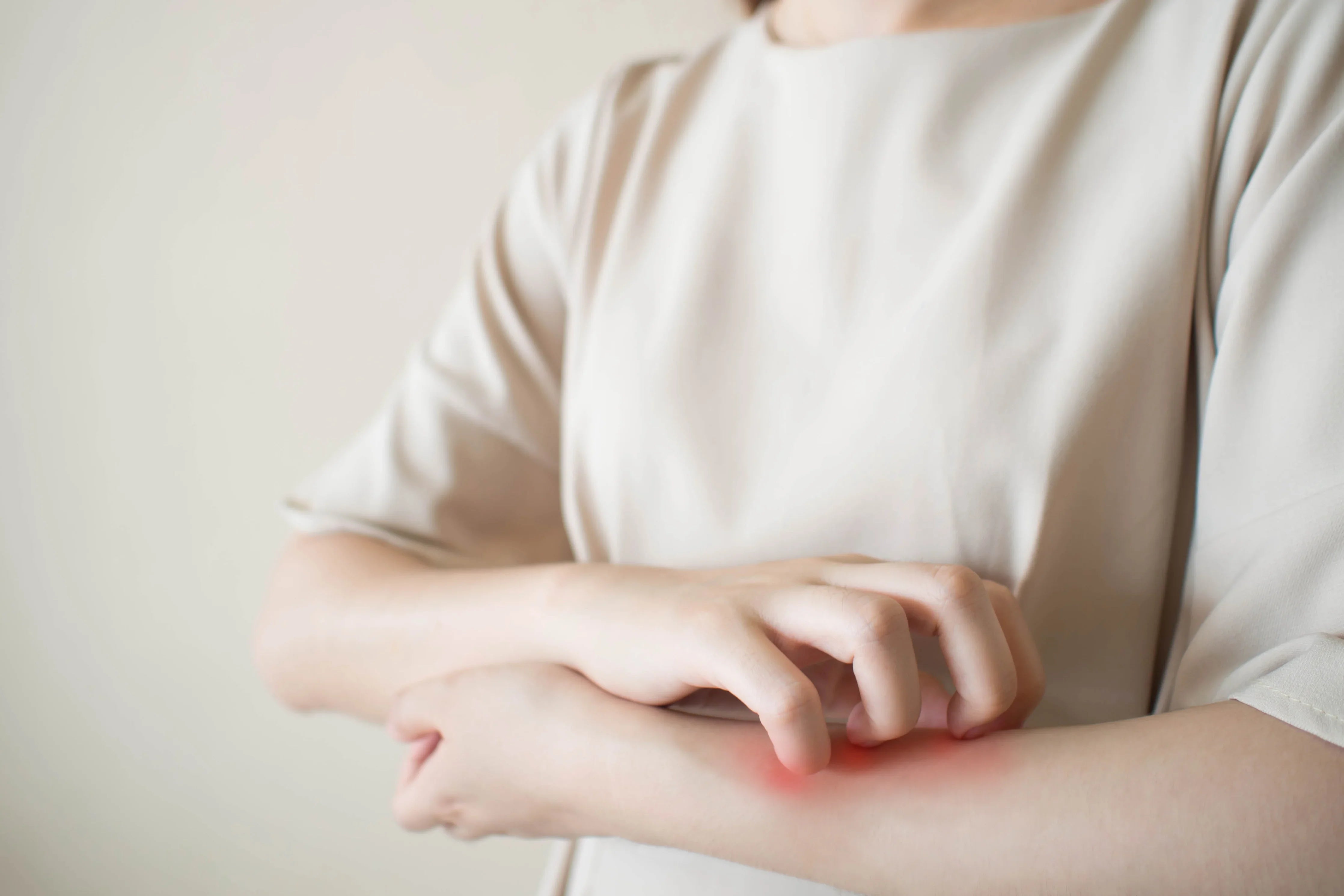 Woman scratching her irritated arm, possible skin allergy, wearing light cotton clothes